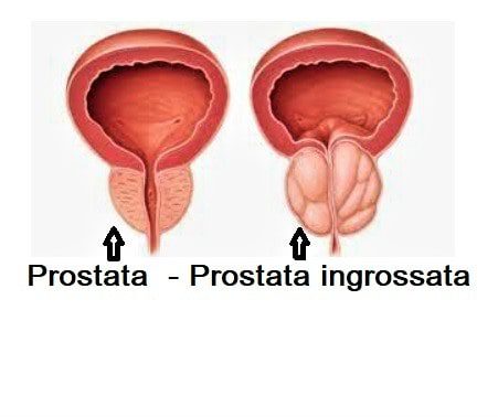 Prostata normale - Prostata ingrossata