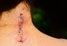 Sognare vecchi amici con delle cicatrici simbolismo e numerologia cicatrice