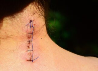 Sognare vecchi amici con delle cicatrici simbolismo e numerologia cicatrice